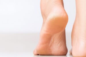 Read more about the article 피부가 건조하다고 생각했는데, 사실은 당뇨병 징후일 수도 있다?